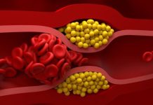 Ako imate povišen holesterol nikako nemojte ovo da jedete! Stvara ozbiljne probleme