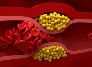 Ako imate povišen holesterol nikako nemojte ovo da jedete! Stvara ozbiljne probleme